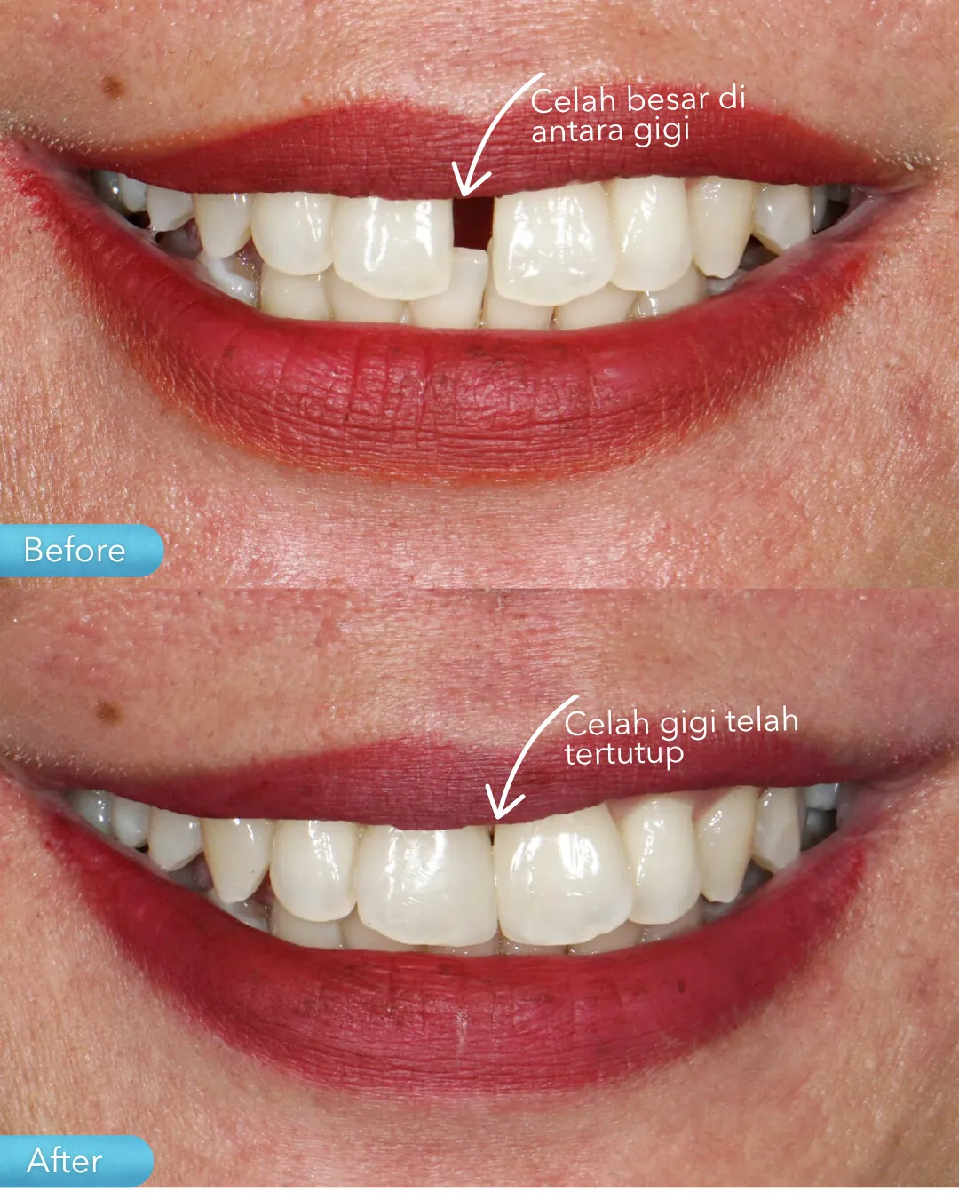 Dental filling result